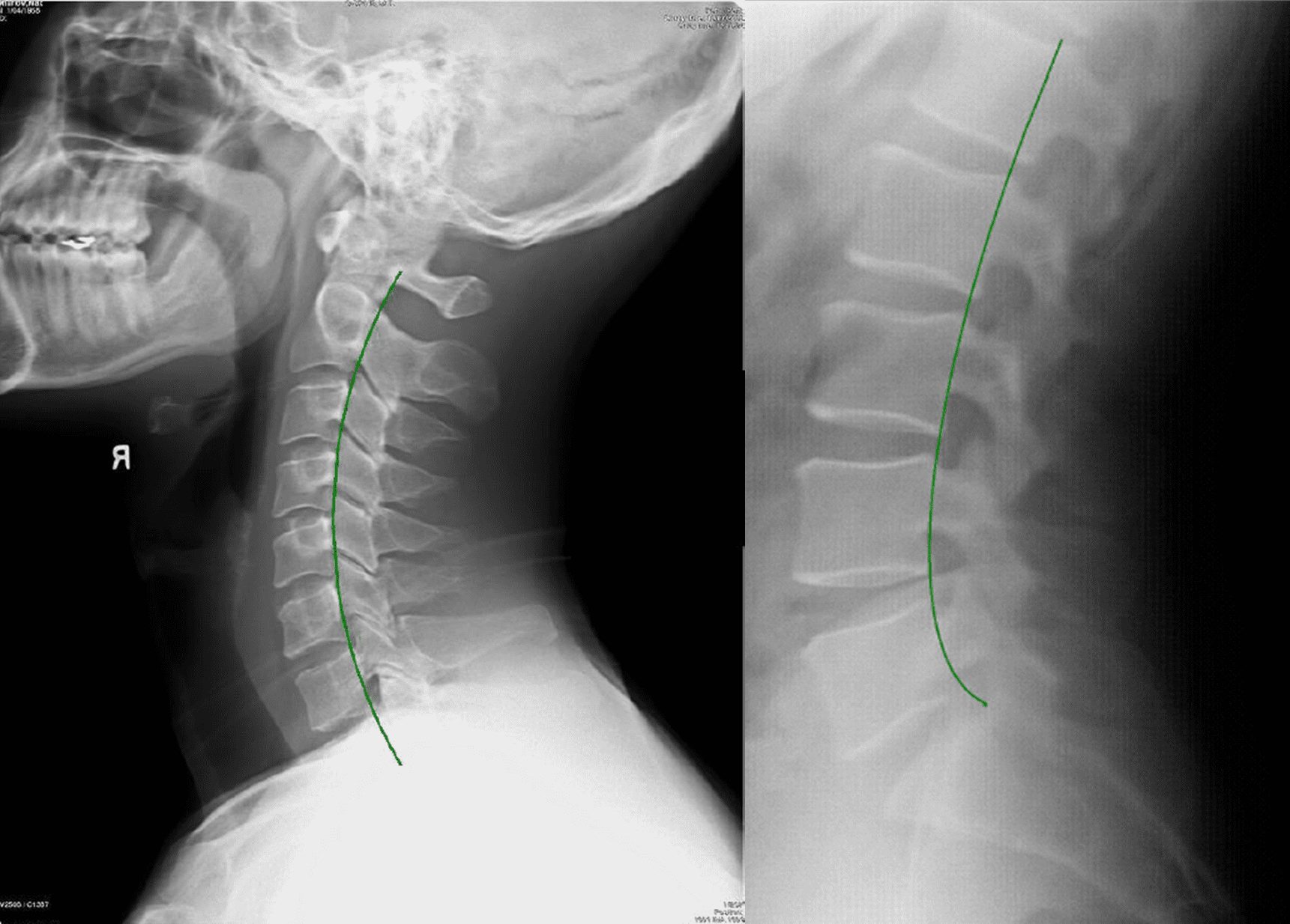 Cervical Alignment and its Impact on Spinal Health - Complete