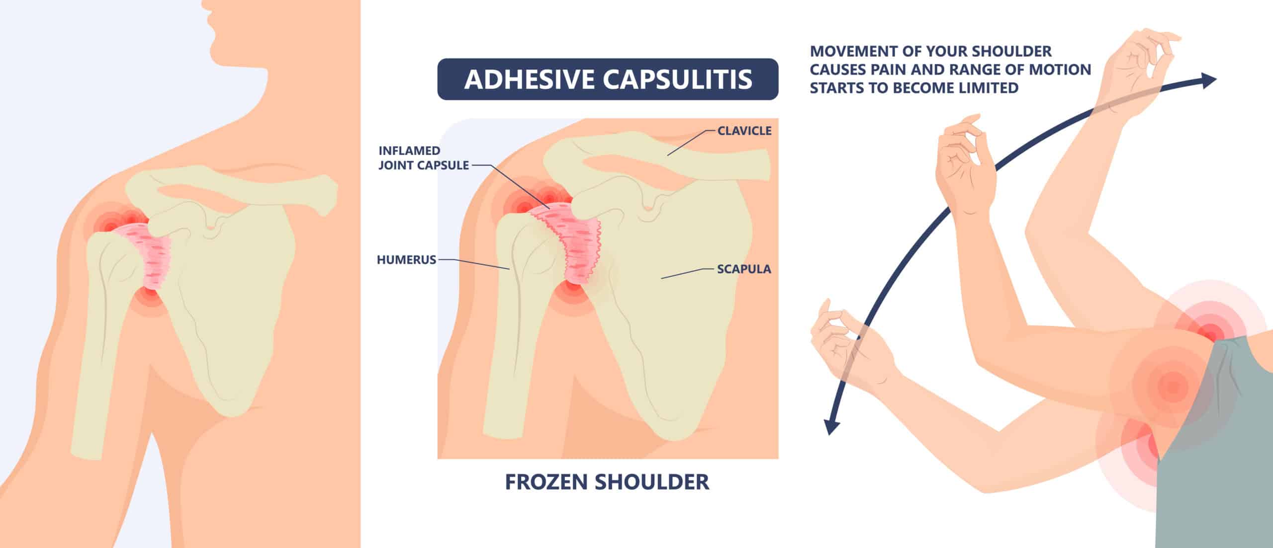 The Benefits of Chiropractic Care For Frozen Shoulder Lakewood, CO