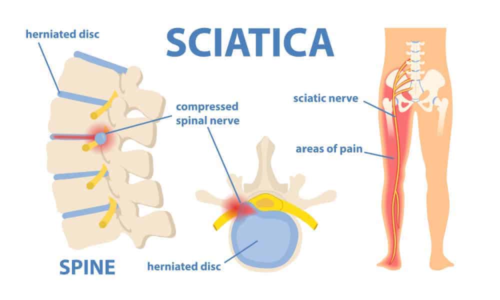 Sciatica diagram