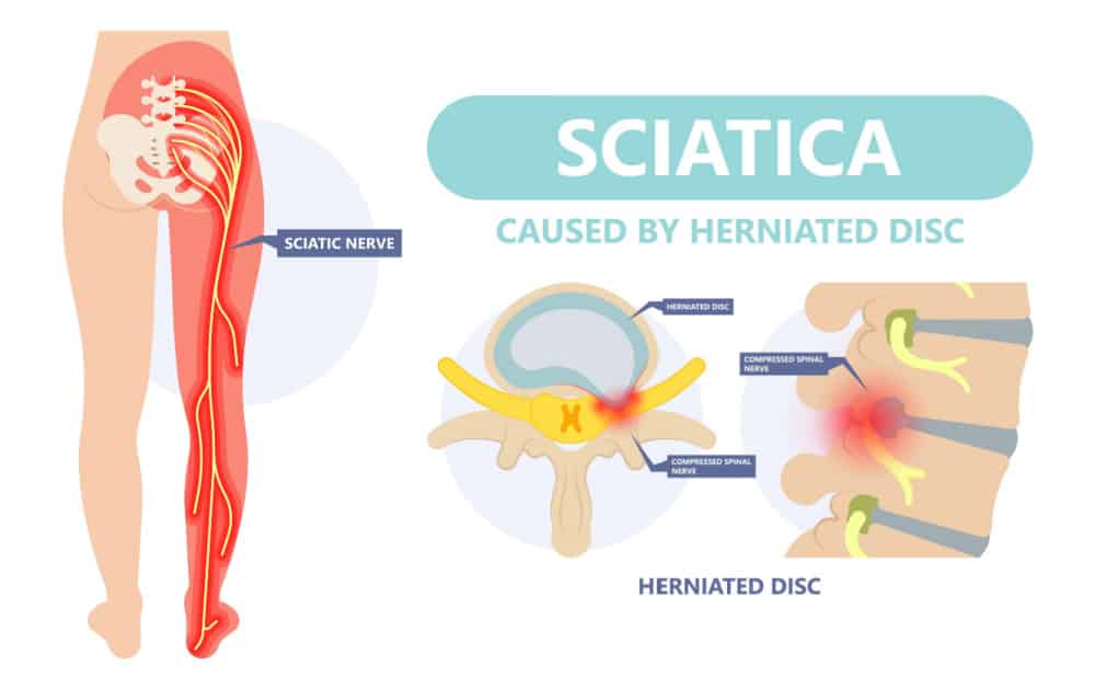 Sciatica Vs Herniated Disc What Are The Differences Denver Sciatica Vs Herniated Disc What Are The Differences Denver