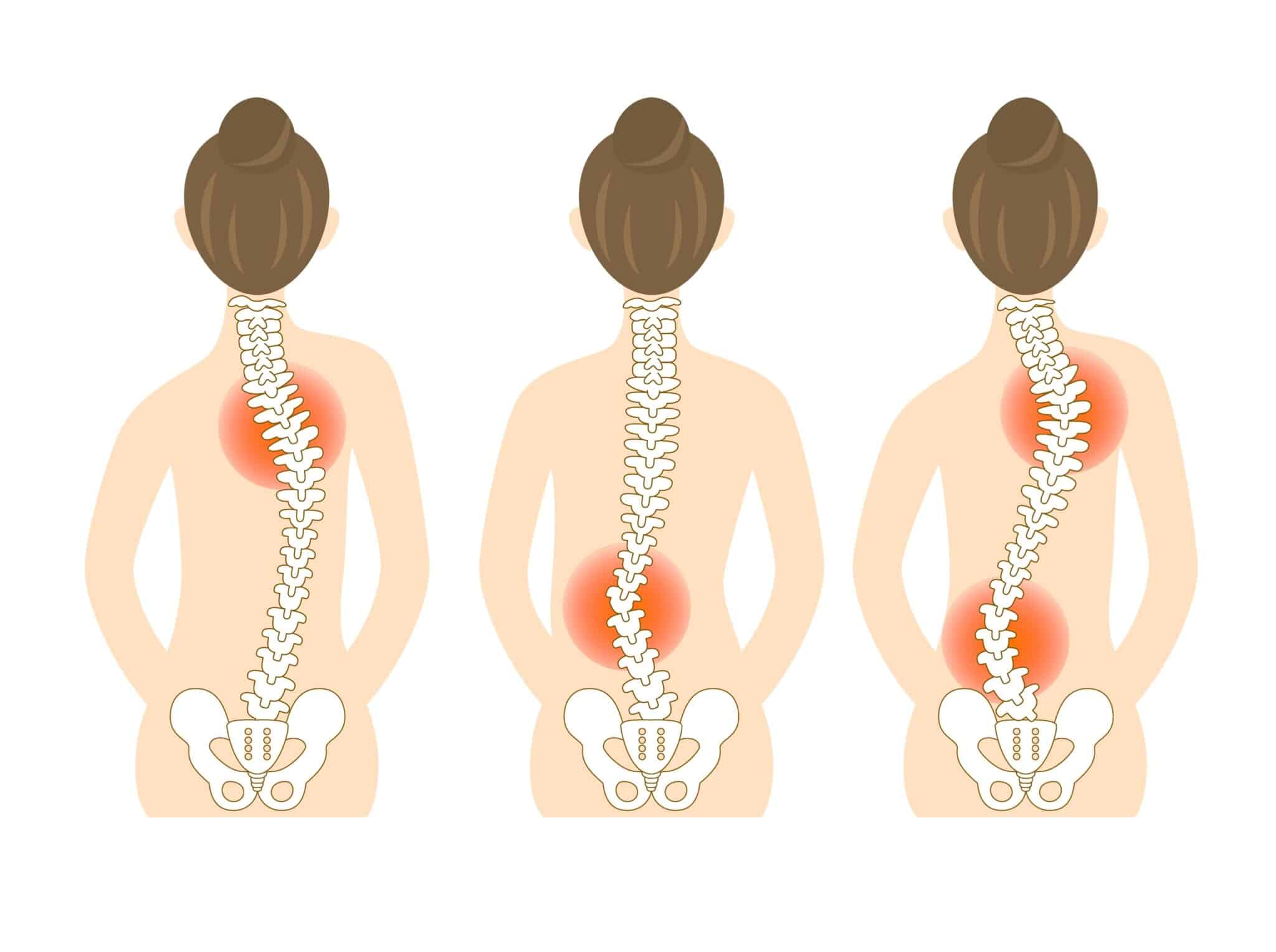 Important Facts About Scoliosis You Should Know Denver | PostureWorks ...