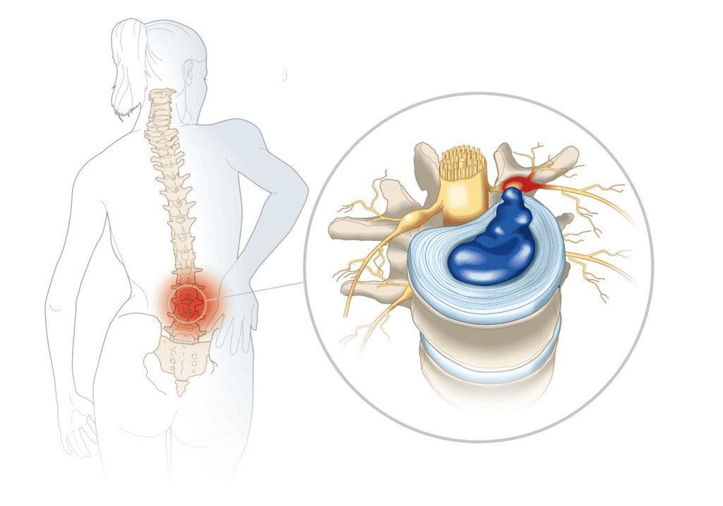 Key Differences Between a Herniated and Bulging Disc a sufferer in